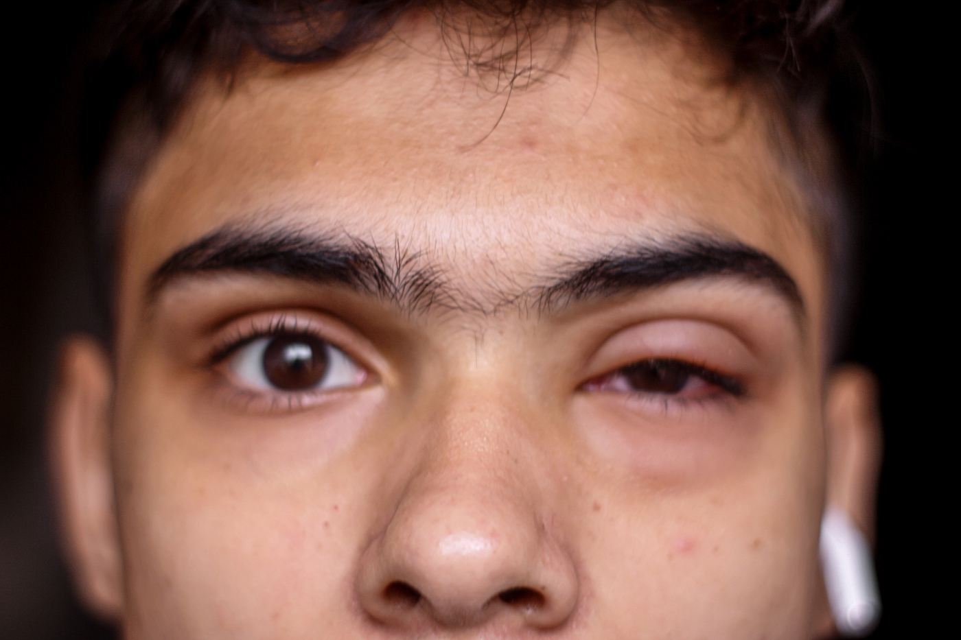 Jongen heeft een oogontsteking conjunctivitis pink eye